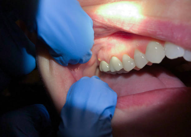 Best Emergency Treatment for Dental Infections or Abscesses in Sansom Park, TX